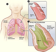 Bronchiectasis_NHLBI